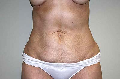 Tummy Tuck Before & After Patient #6940