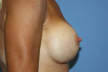 Breast Augmentation Before & After Patient #7100