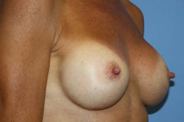 Breast Augmentation Before & After Patient #7100