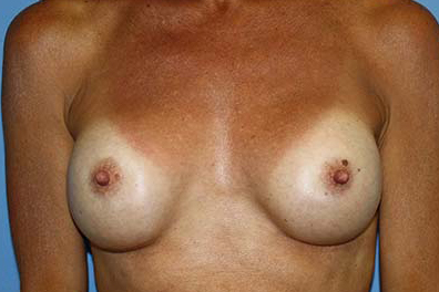 Breast Augmentation Before & After Patient #7100