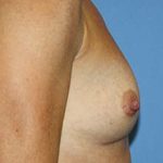 Breast Augmentation Before & After Patient #7100