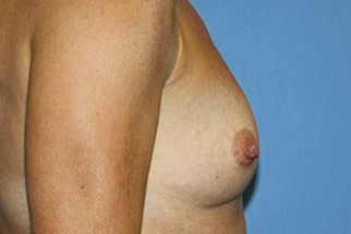 Breast Augmentation Before & After Patient #7100