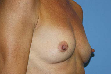 Breast Augmentation Before & After Patient #7100