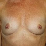 Breast Augmentation Before & After Patient #7100