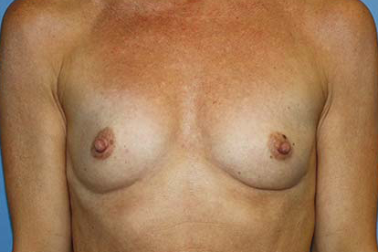 Breast Augmentation Before & After Patient #7100