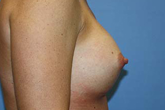 Breast Augmentation Before & After Patient #7094