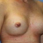Breast Augmentation Before & After Patient #7094