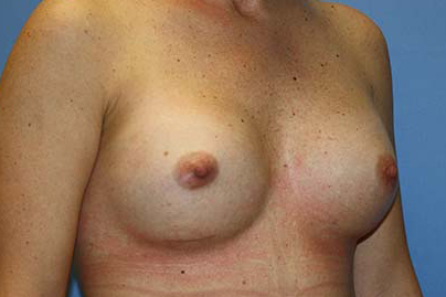 Breast Augmentation Before & After Patient #7094