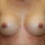 Breast Augmentation Before & After Patient #7094