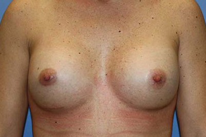Breast Augmentation Before & After Patient #7094