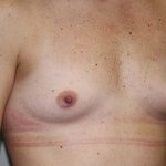 Breast Augmentation Before & After Patient #7094