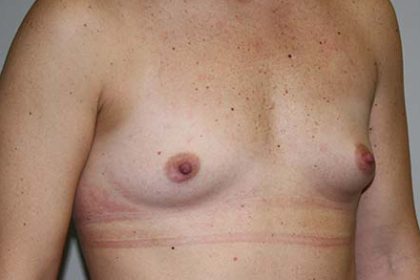 Breast Augmentation Before & After Patient #7094