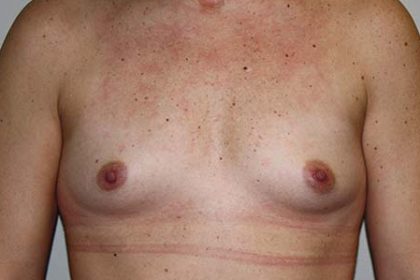 Breast Augmentation Before & After Patient #7094