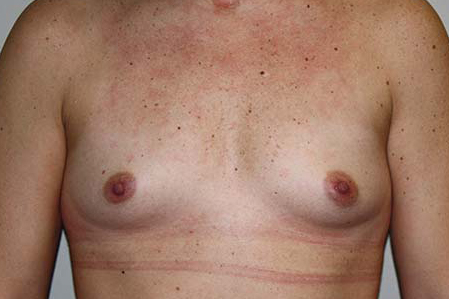 Breast Augmentation Before & After Patient #7094