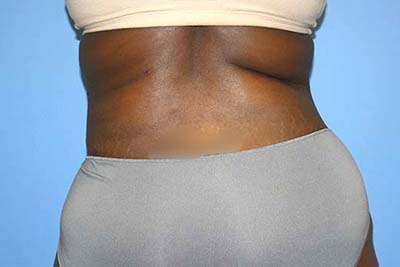 Tummy Tuck Before & After Patient #5764