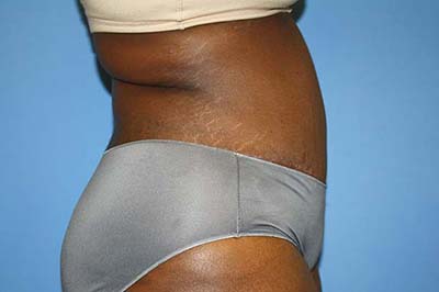 Tummy Tuck Before & After Patient #5764