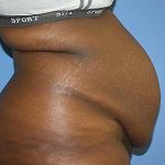 Tummy Tuck Before & After Patient #5764