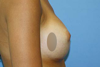 Breast Augmentation Before & After Patient #5765