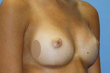 Breast Augmentation Before & After Patient #5765