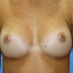 Breast Augmentation Before & After Patient #5765