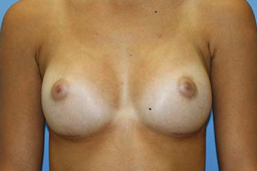 Breast Augmentation Before & After Patient #5765