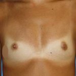 Breast Augmentation Before & After Patient #5765