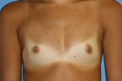 Breast Augmentation Before & After Patient #5765