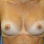 Breast Augmentation Before & After Patient #5768