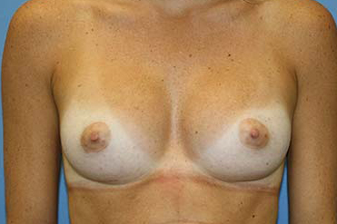 Breast Augmentation Before & After Patient #5768