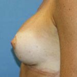 Breast Augmentation Before & After Patient #5768