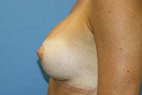 Breast Augmentation Before & After Patient #5768