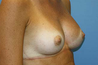 Breast Augmentation Before & After Patient #5768