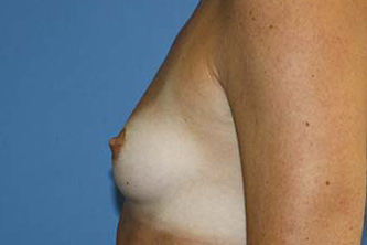 Breast Augmentation Before & After Patient #5768