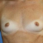 Breast Augmentation Before & After Patient #5768