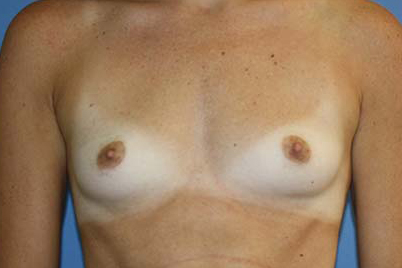 Breast Augmentation Before & After Patient #5768