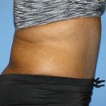 Tummy Tuck Before & After Patient #5586