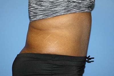 Tummy Tuck Before & After Patient #5586