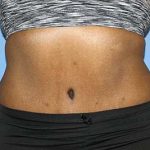 Tummy Tuck Before & After Patient #5586