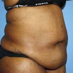 Tummy Tuck Before & After Patient #5586