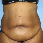 Tummy Tuck Before & After Patient #5586