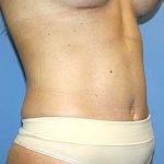 Tummy Tuck Before & After Patient #7240