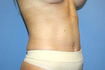 Tummy Tuck Before & After Patient #7240