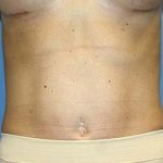 Tummy Tuck Before & After Patient #7240