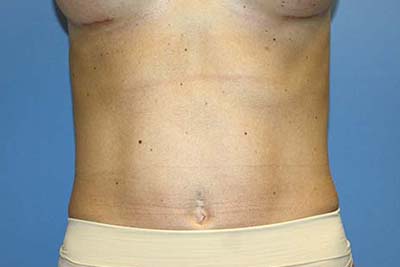 Tummy Tuck Before & After Patient #7240