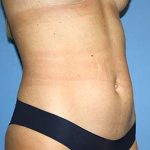 Tummy Tuck Before & After Patient #7240