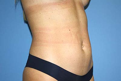 Tummy Tuck Before & After Patient #7240