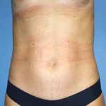 Tummy Tuck Before & After Patient #7240