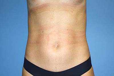 Tummy Tuck Before & After Patient #7240