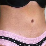 Tummy Tuck Before & After Patient #5590