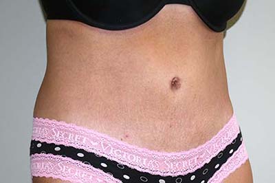 Tummy Tuck Before & After Patient #5590